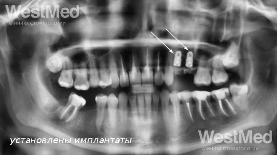 Первый этап: Удаление 2 зубов с одномоментной имплантацией