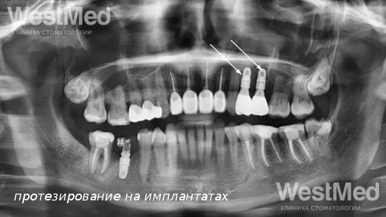 Второй этап: Протезирование циркониевыми коронками