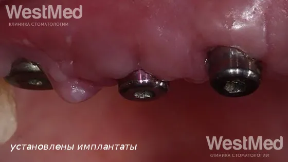 Первый этап: Установка имплантатов