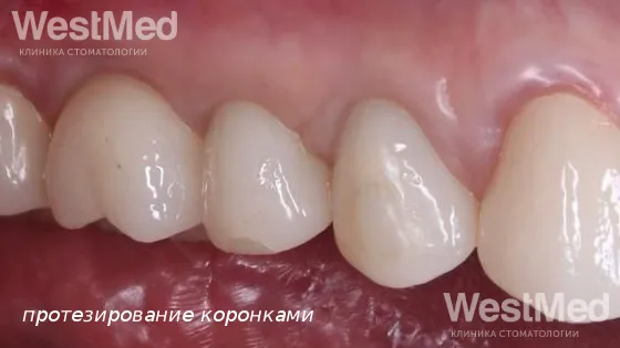 Второй этап: Протезирование на имплантатах и зубах